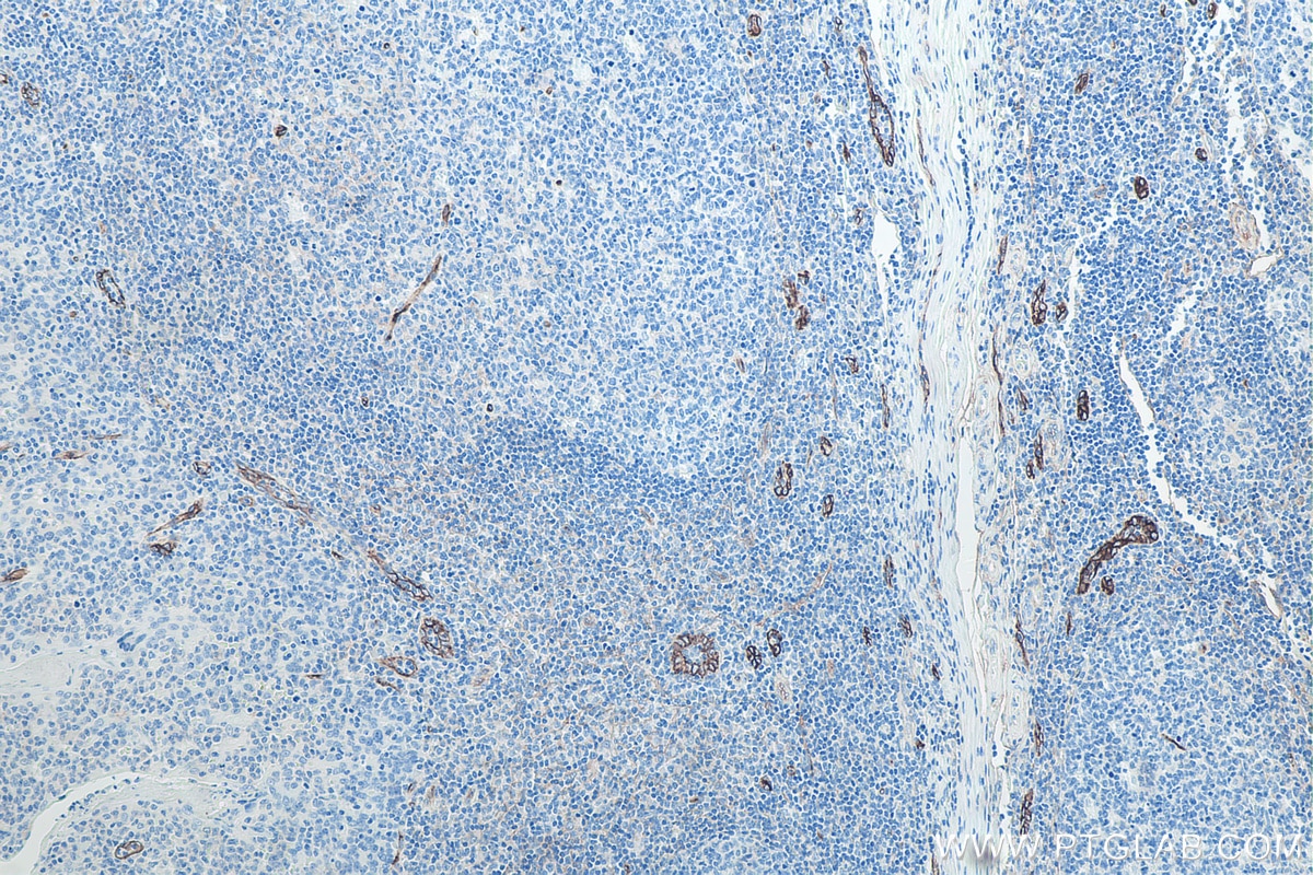 IHC staining of human tonsillitis using 67075-1-Ig Immunohistochemistry (IHC) staining of human tonsillitis tissue using Endoglin/CD105 Monoclonal antibody (67075-1-Ig)