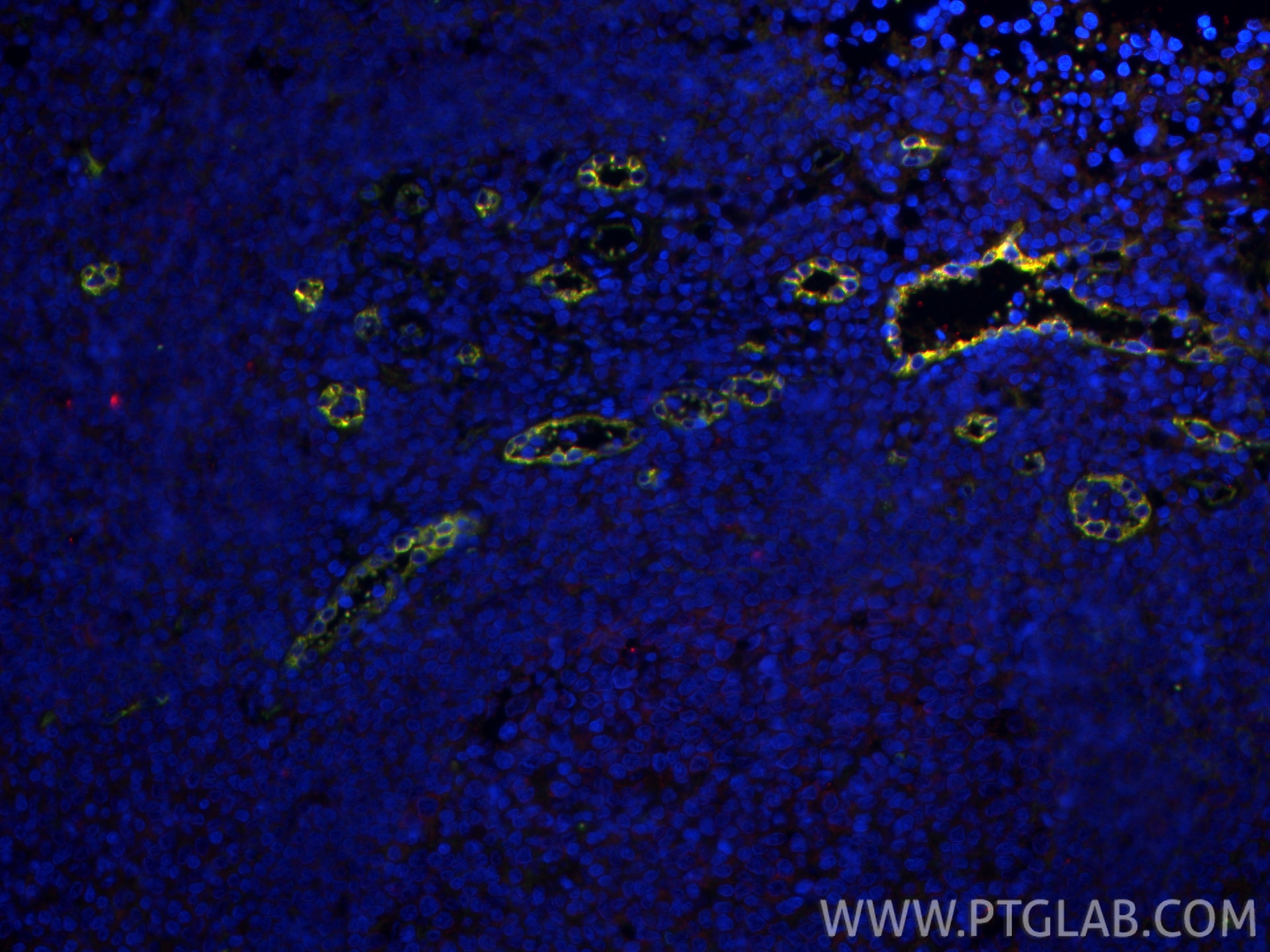 IF Staining of human tonsillitis using 82993-6-RR (same clone as 82993-6-PBS) Immunofluorescence (IF) / fluorescent staining of human tonsillitis tissue using Endoglin/CD105 Recombinant monoclonal antibody (82993-6-RR)