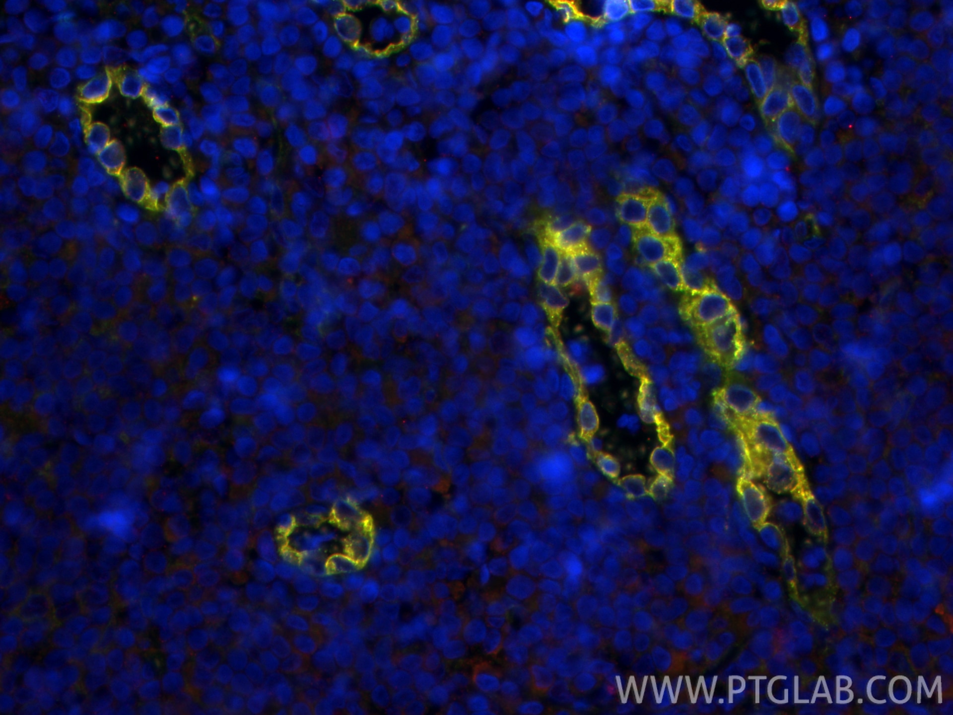 IF Staining of human tonsillitis using 82993-6-RR (same clone as 82993-6-PBS) Immunofluorescence (IF) / fluorescent staining of human tonsillitis tissue using Endoglin/CD105 Recombinant monoclonal antibody (82993-6-RR)