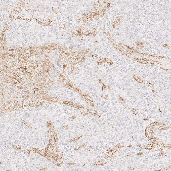 IHC staining of human liver cancer using 82993-6-RR Immunohistochemistry (IHC) staining of human liver cancer tissue using Endoglin/CD105 Recombinant monoclonal antibody (82993-6-RR)