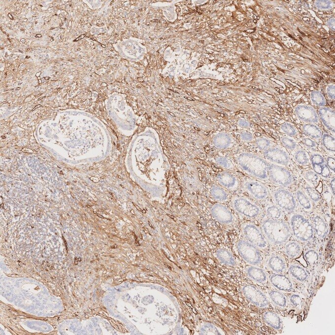 IHC staining of human colorectal cancer using 82993-6-RR Immunohistochemistry (IHC) staining of human colorectal cancer tissue using Endoglin/CD105 Recombinant monoclonal antibody (82993-6-RR)