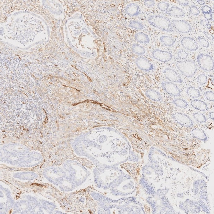 IHC staining of human colorectal cancer using 82993-6-RR Immunohistochemistry (IHC) staining of human colorectal cancer tissue using Endoglin/CD105 Recombinant monoclonal antibody (82993-6-RR)