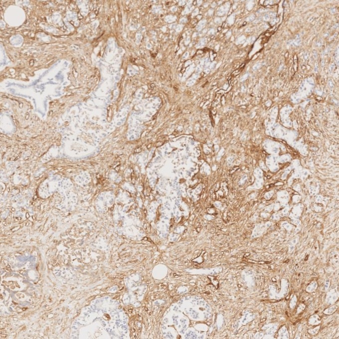 IHC staining of human pancreas cancer using 82993-6-RR Immunohistochemistry (IHC) staining of human pancreas cancer tissue using Endoglin/CD105 Recombinant monoclonal antibody (82993-6-RR)