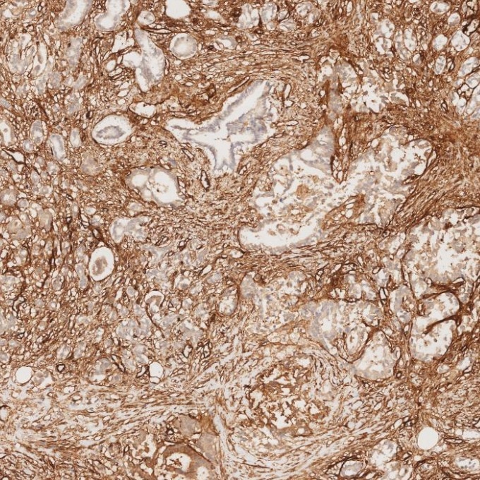 IHC staining of human pancreas cancer using 82993-6-RR Immunohistochemistry (IHC) staining of human pancreas cancer tissue using Endoglin/CD105 Recombinant monoclonal antibody (82993-6-RR)