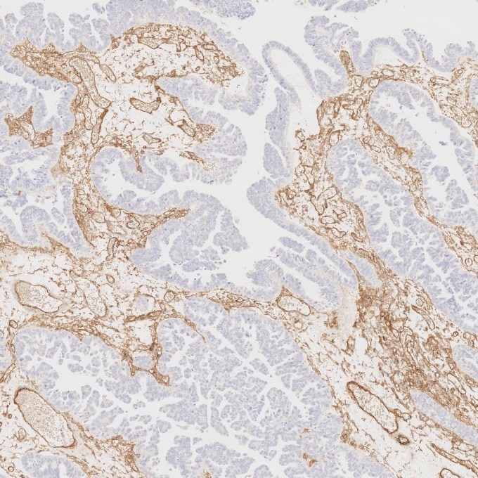 IHC staining of human ovary cancer using 82993-6-RR Immunohistochemistry (IHC) staining of human ovary cancer tissue using Endoglin/CD105 Recombinant monoclonal antibody (82993-6-RR)