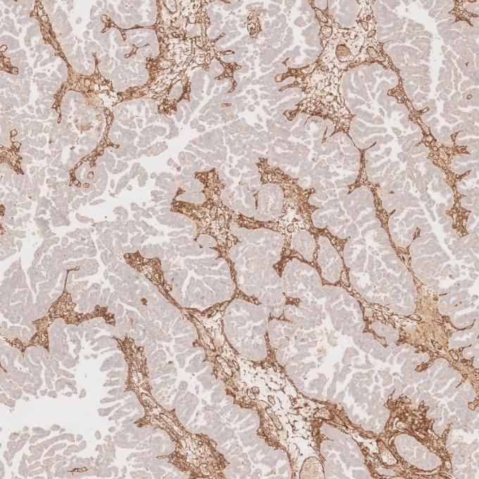 IHC staining of human ovary cancer using 82993-6-RR Immunohistochemistry (IHC) staining of human ovary cancer tissue using Endoglin/CD105 Recombinant monoclonal antibody (82993-6-RR)