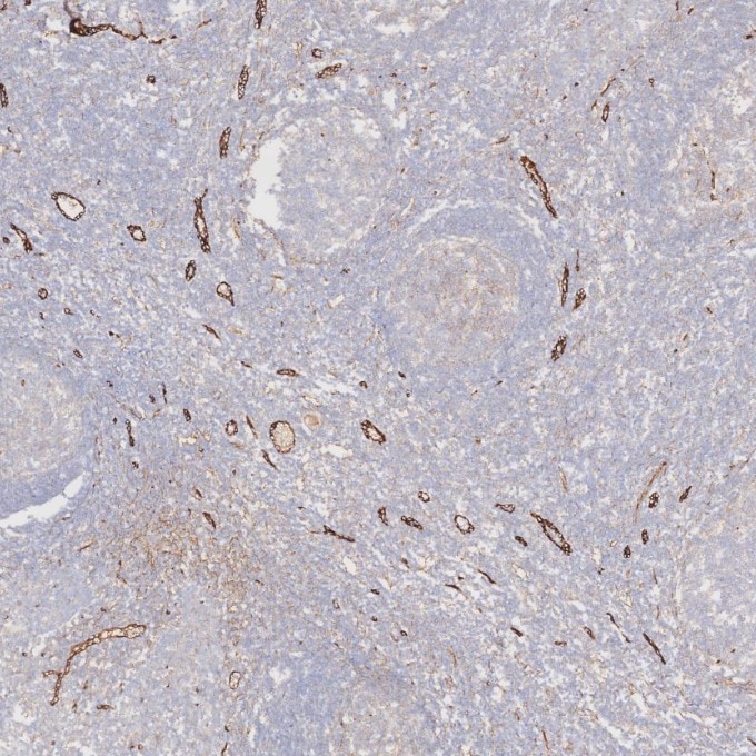 IHC staining of human tonsillitis using 82993-6-RR Immunohistochemistry (IHC) staining of human tonsillitis tissue using Endoglin/CD105 Recombinant monoclonal antibody (82993-6-RR)