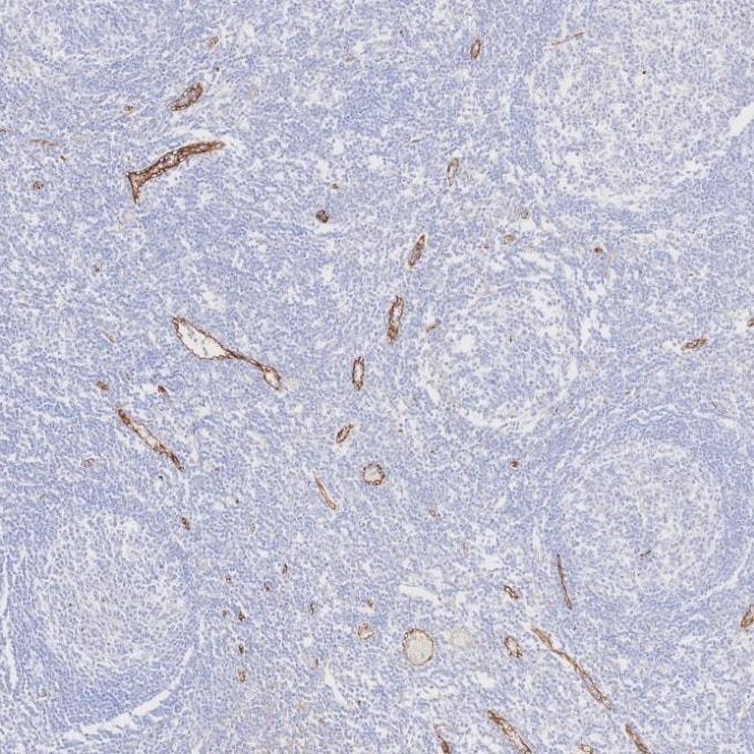 IHC staining of human tonsillitis using 82993-6-RR Immunohistochemistry (IHC) staining of human tonsillitis tissue using Endoglin/CD105 Recombinant monoclonal antibody (82993-6-RR)