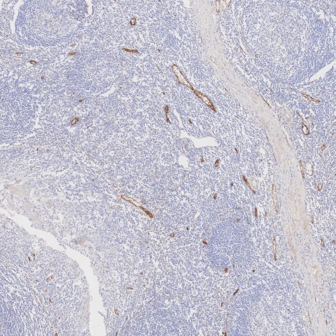 IHC staining of human tonsillitis using 82993-6-RR Immunohistochemistry (IHC) staining of human tonsillitis tissue using Endoglin/CD105 Recombinant monoclonal antibody (82993-6-RR)