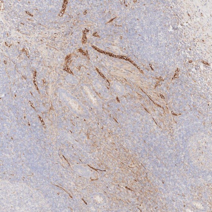 IHC staining of human appendicitis using 82993-6-RR Immunohistochemistry (IHC) staining of human appendicitis tissue using Endoglin/CD105 Recombinant monoclonal antibody (82993-6-RR)
