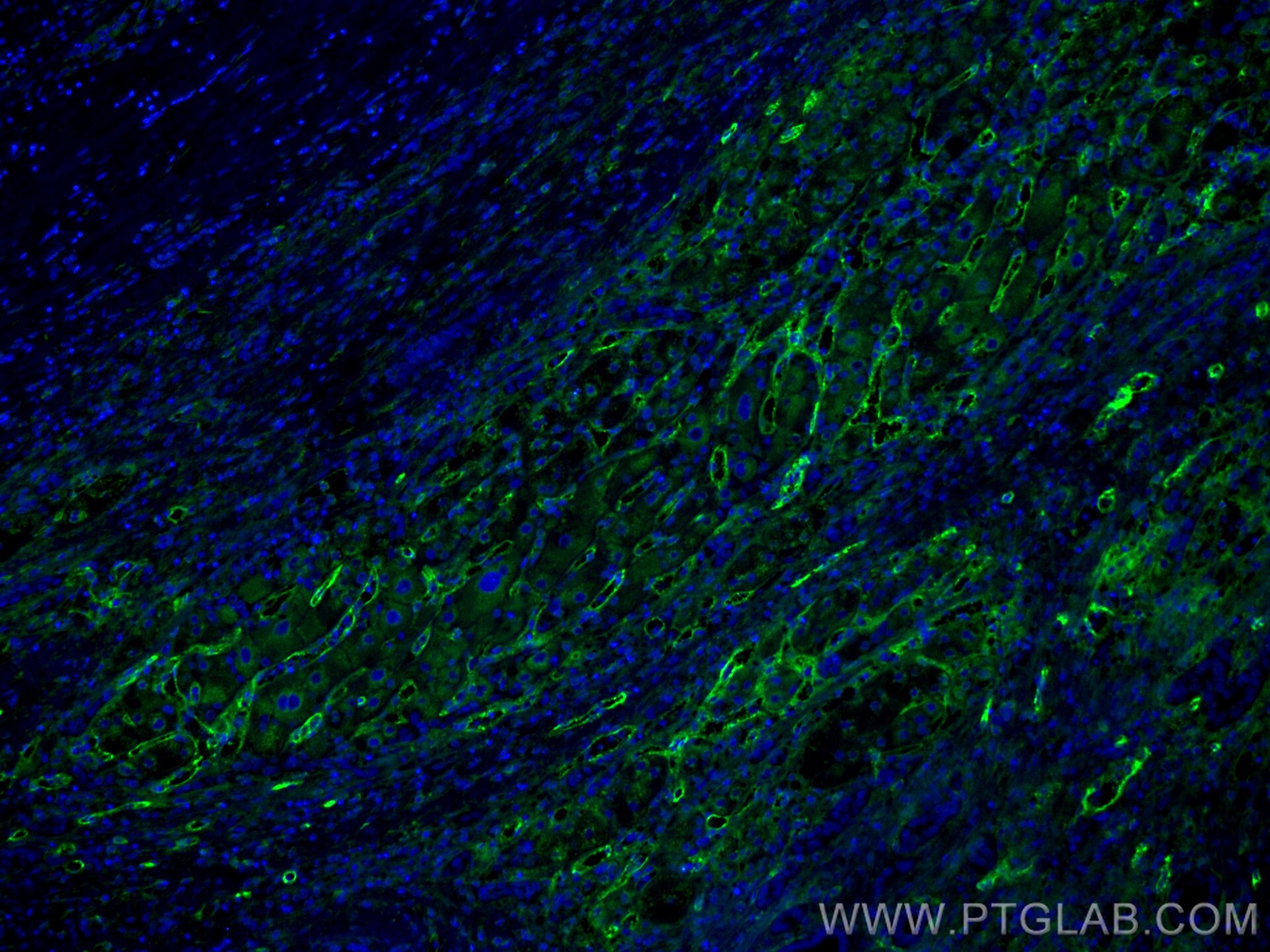 Immunofluorescence (IF) / fluorescent staining of Human liver cancer tissue using CoraLite® Plus 488-conjugated Endoglin/CD105 Monoc (CL488-67075)