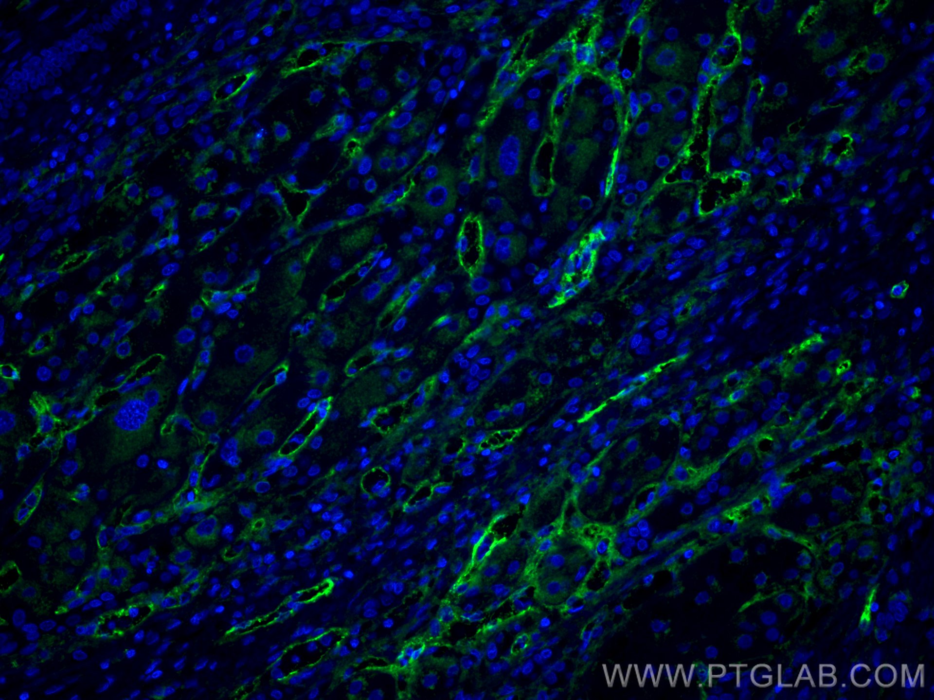 Immunofluorescence (IF) / fluorescent staining of Human liver cancer tissue using CoraLite® Plus 488-conjugated Endoglin/CD105 Monoc (CL488-67075)
