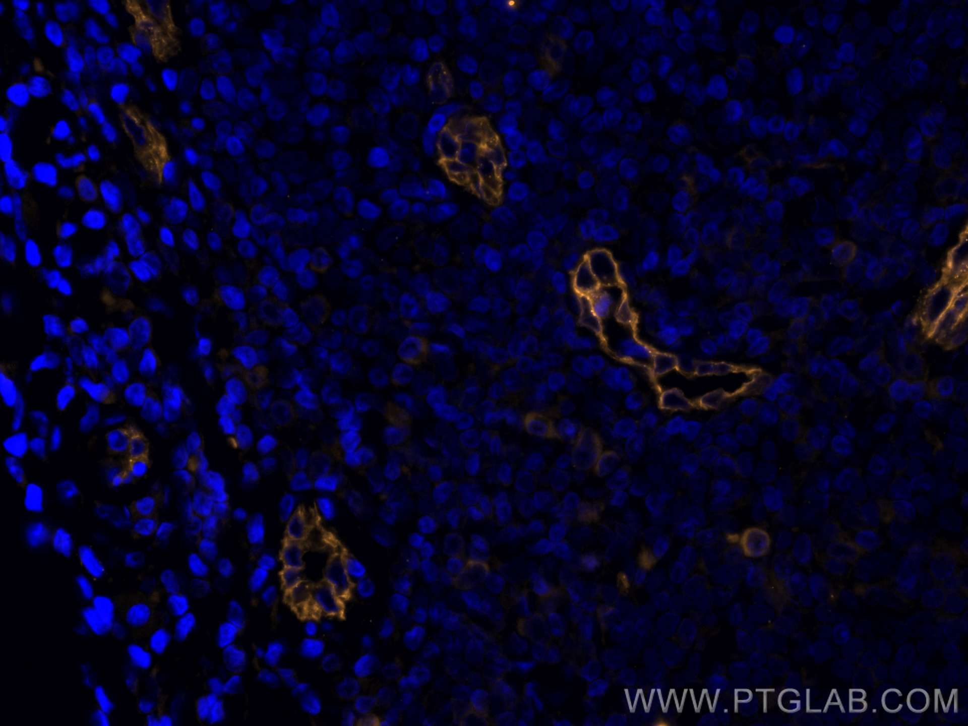 IF Staining of human breast cancer using CL555-67075