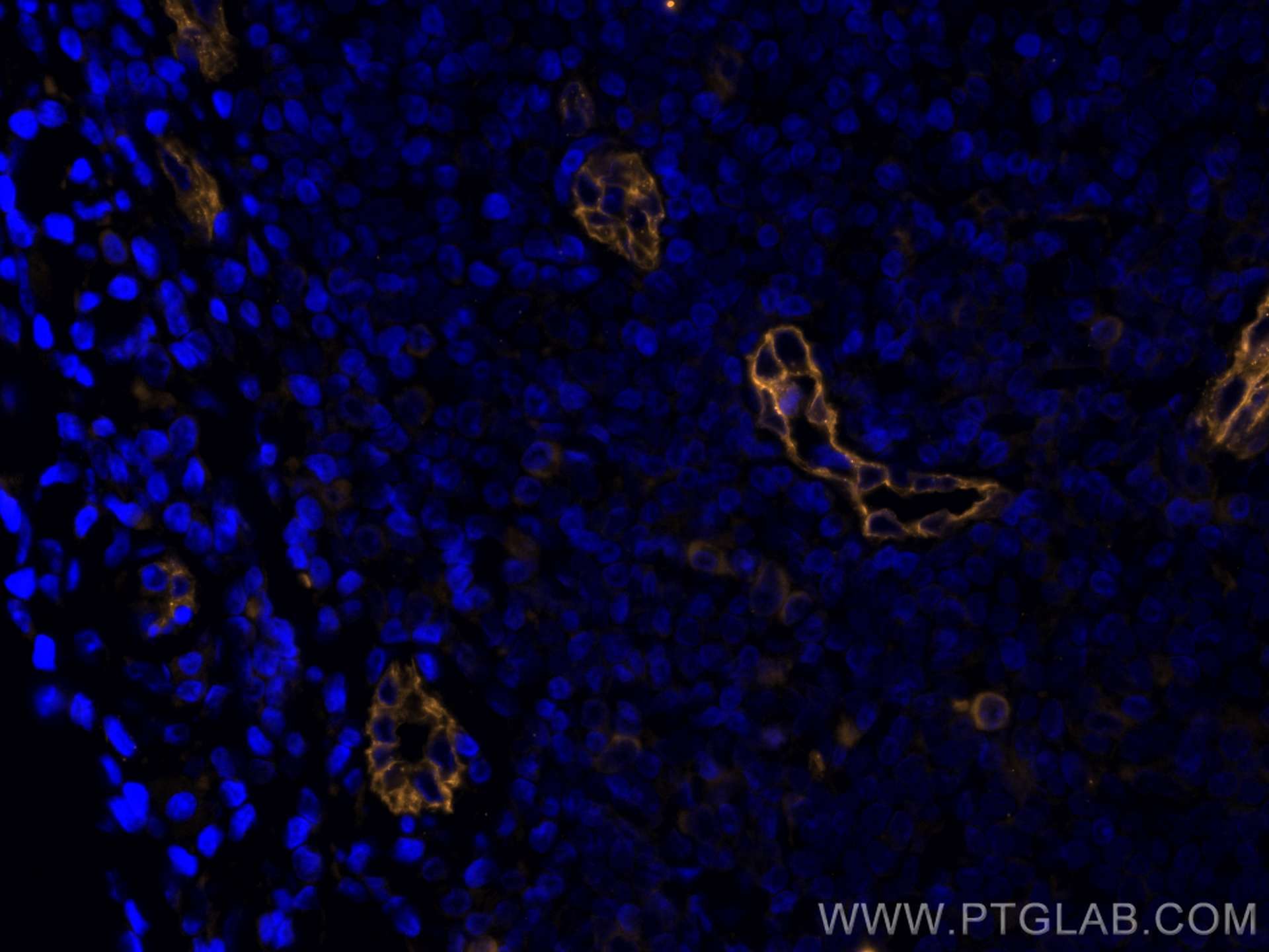 Immunofluorescence (IF) / fluorescent staining of human breast cancer tissue using CoraLite®555-conjugated Endoglin/CD105 Monoclonal  (CL555-67075)