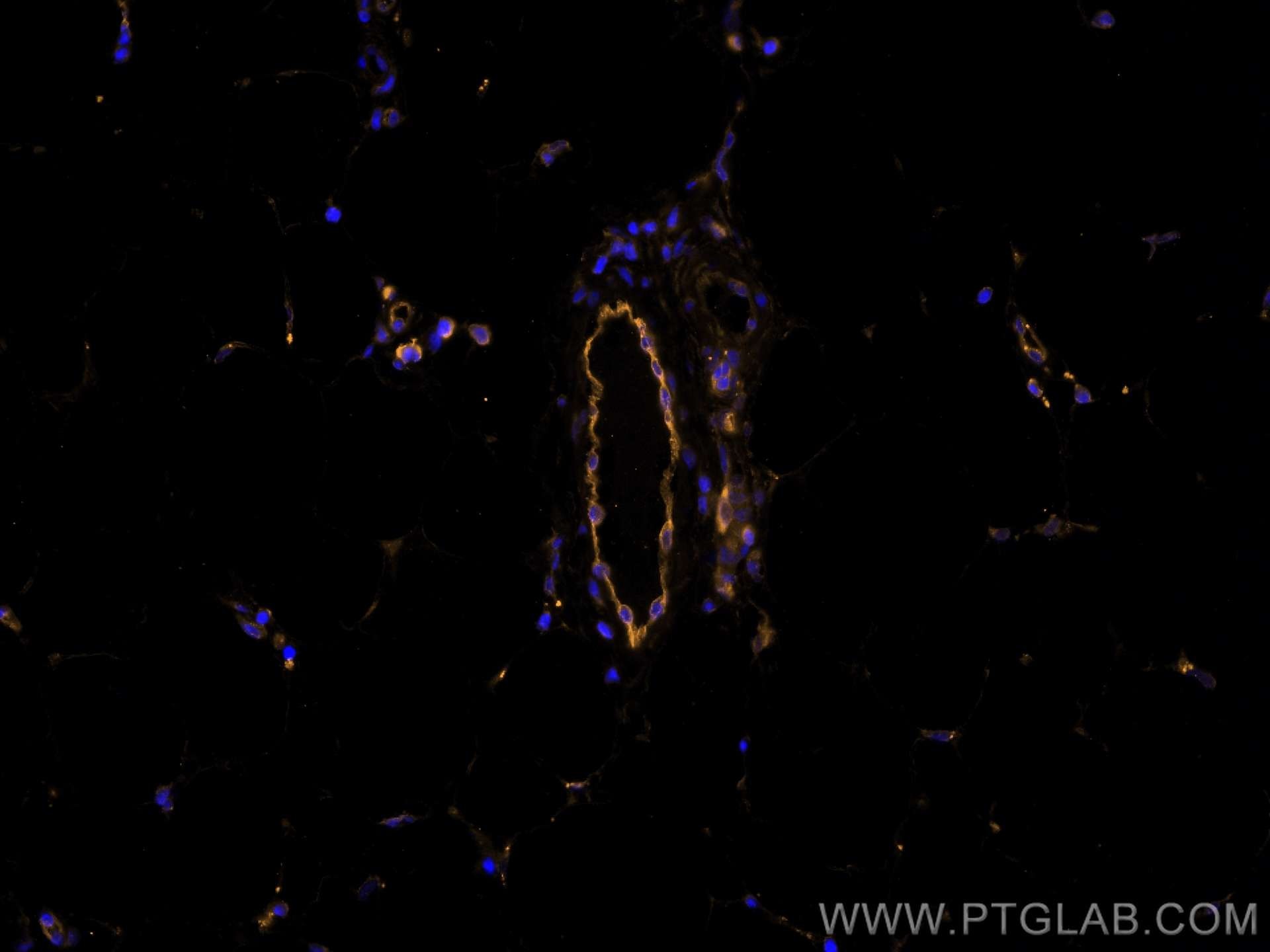 Immunofluorescence (IF) / fluorescent staining of human breast cancer tissue using CoraLite®555-conjugated Endoglin/CD105 Monoclonal  (CL555-67075)