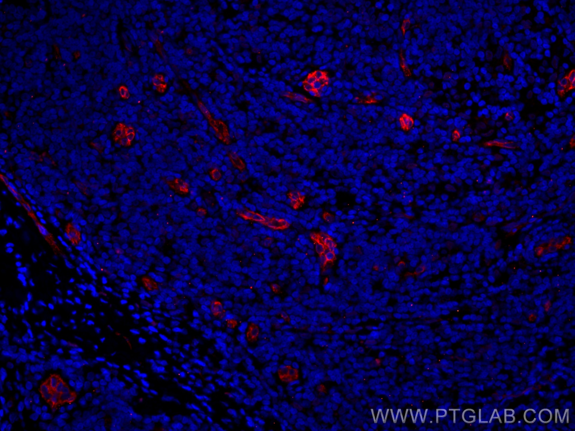 IF Staining of human breast cancer using CL594-67075