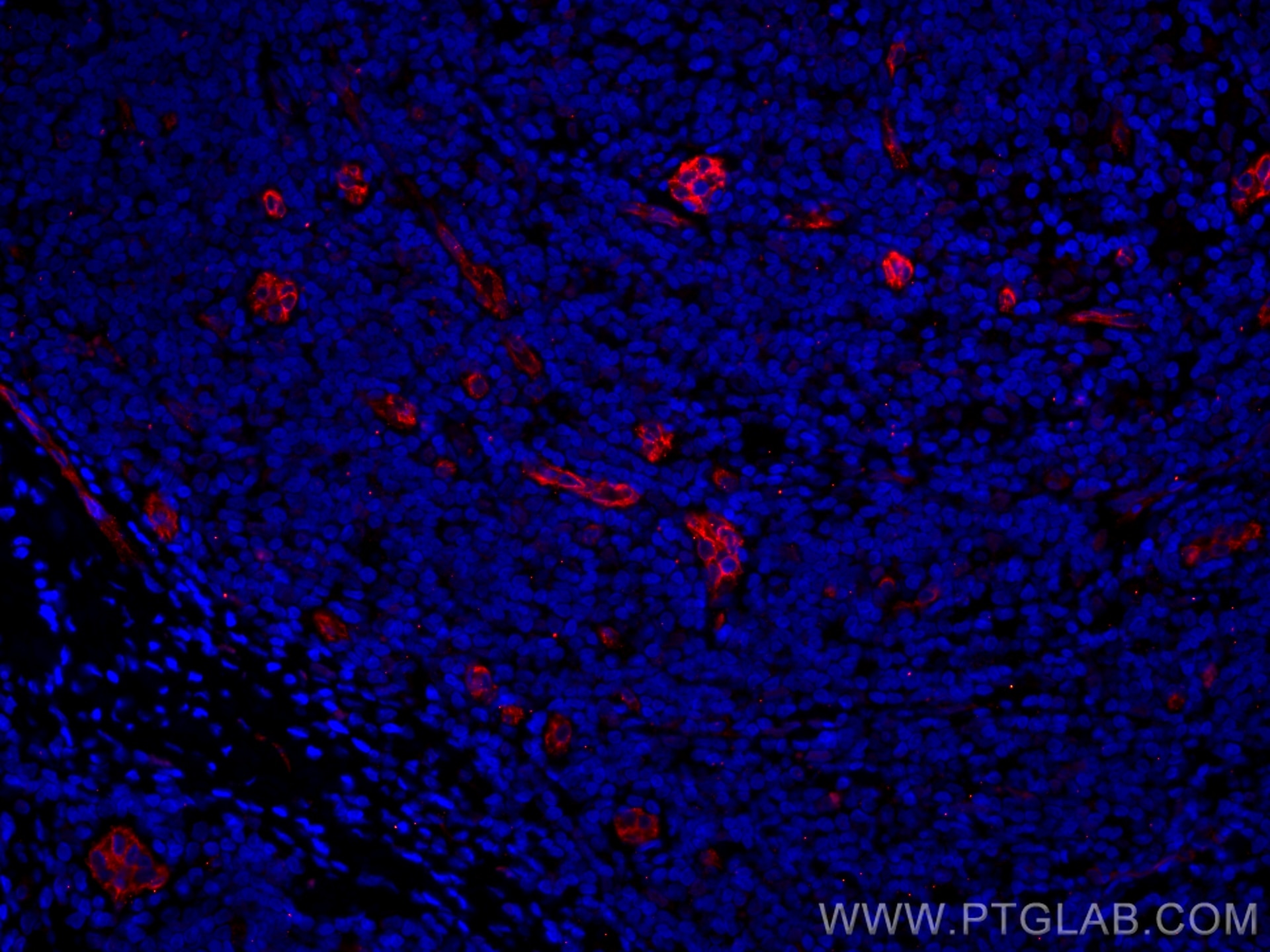 Immunofluorescence (IF) / fluorescent staining of human breast cancer tissue using CoraLite®594-conjugated Endoglin/CD105 Monoclonal  (CL594-67075)