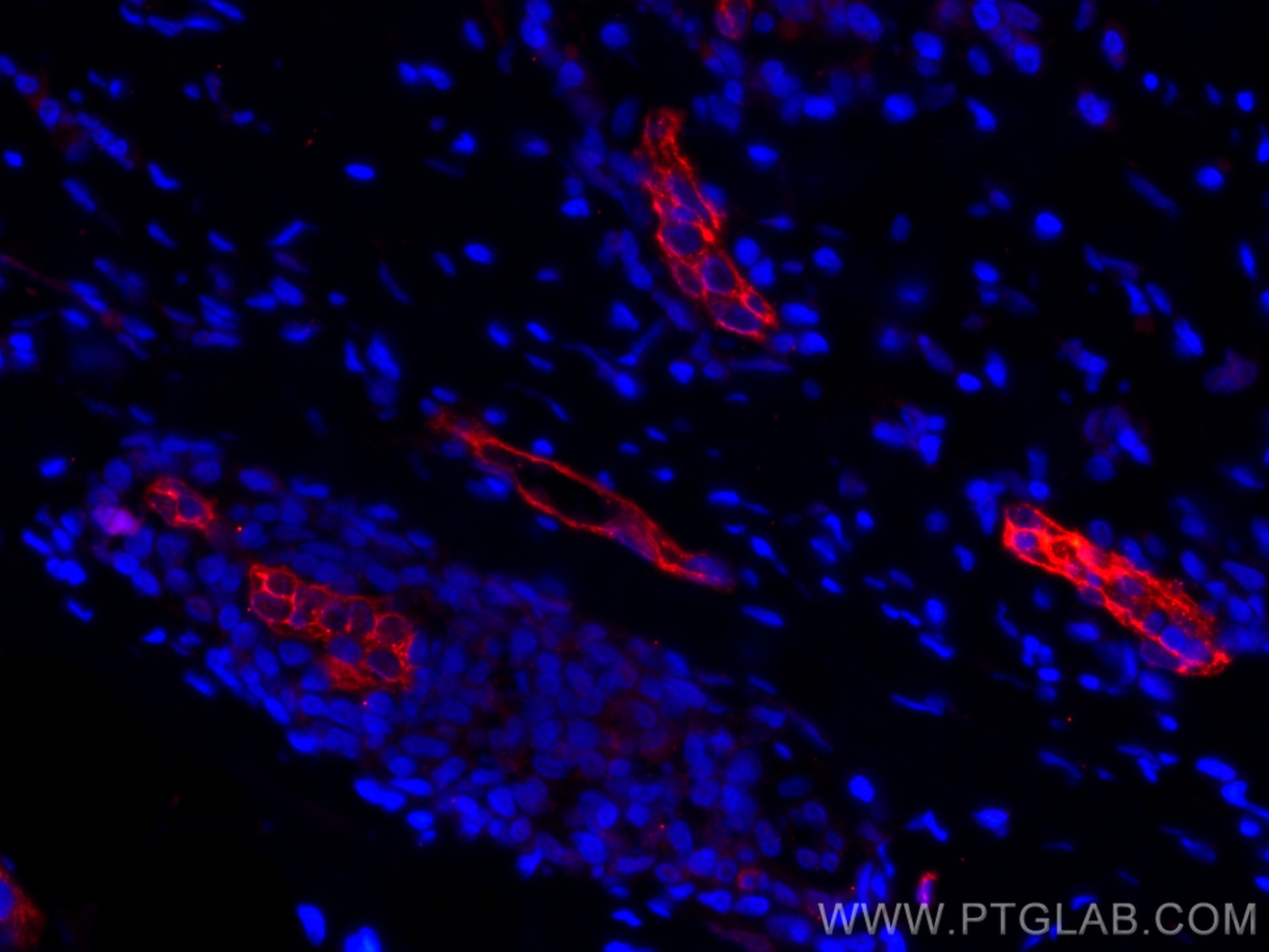 Immunofluorescence (IF) / fluorescent staining of human breast cancer tissue using CoraLite®594-conjugated Endoglin/CD105 Monoclonal  (CL594-67075)