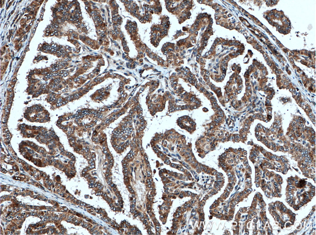 Immunohistochemistry (IHC) staining of human thyroid cancer tissue using Endothelin 3 Polyclonal antibody (27871-1-AP)