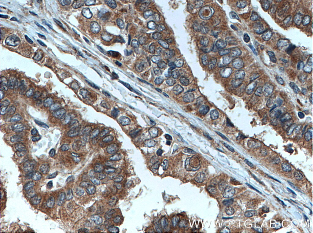 Immunohistochemistry (IHC) staining of human thyroid cancer tissue using Endothelin 3 Polyclonal antibody (27871-1-AP)