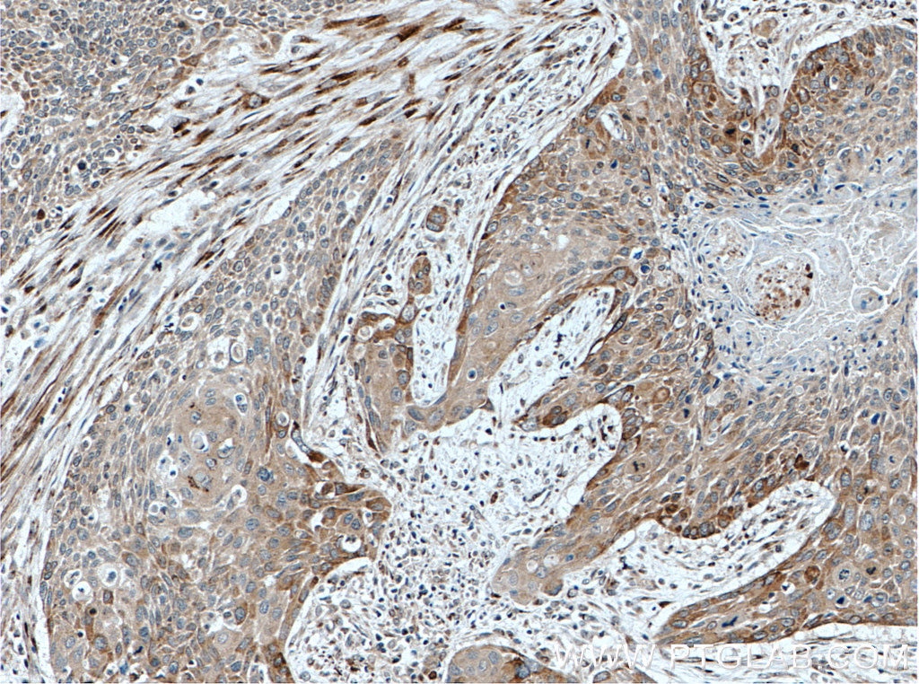 Immunohistochemistry (IHC) staining of human oesophagus cancer tissue using Endothelin 3 Polyclonal antibody (27871-1-AP)