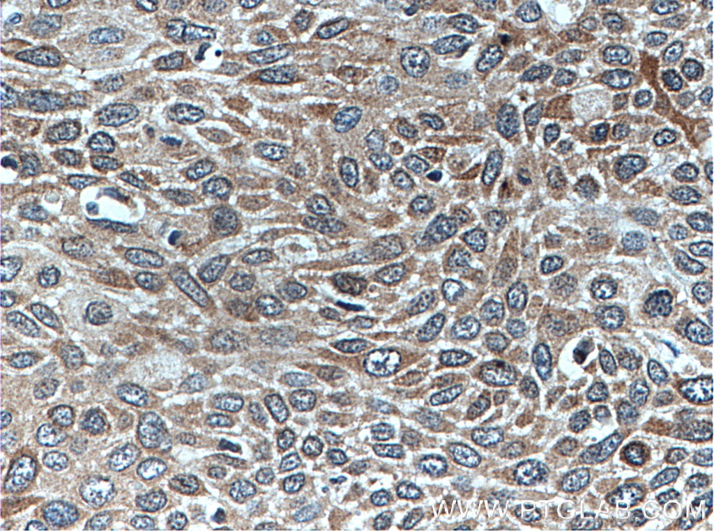 Immunohistochemistry (IHC) staining of human oesophagus cancer tissue using Endothelin 3 Polyclonal antibody (27871-1-AP)
