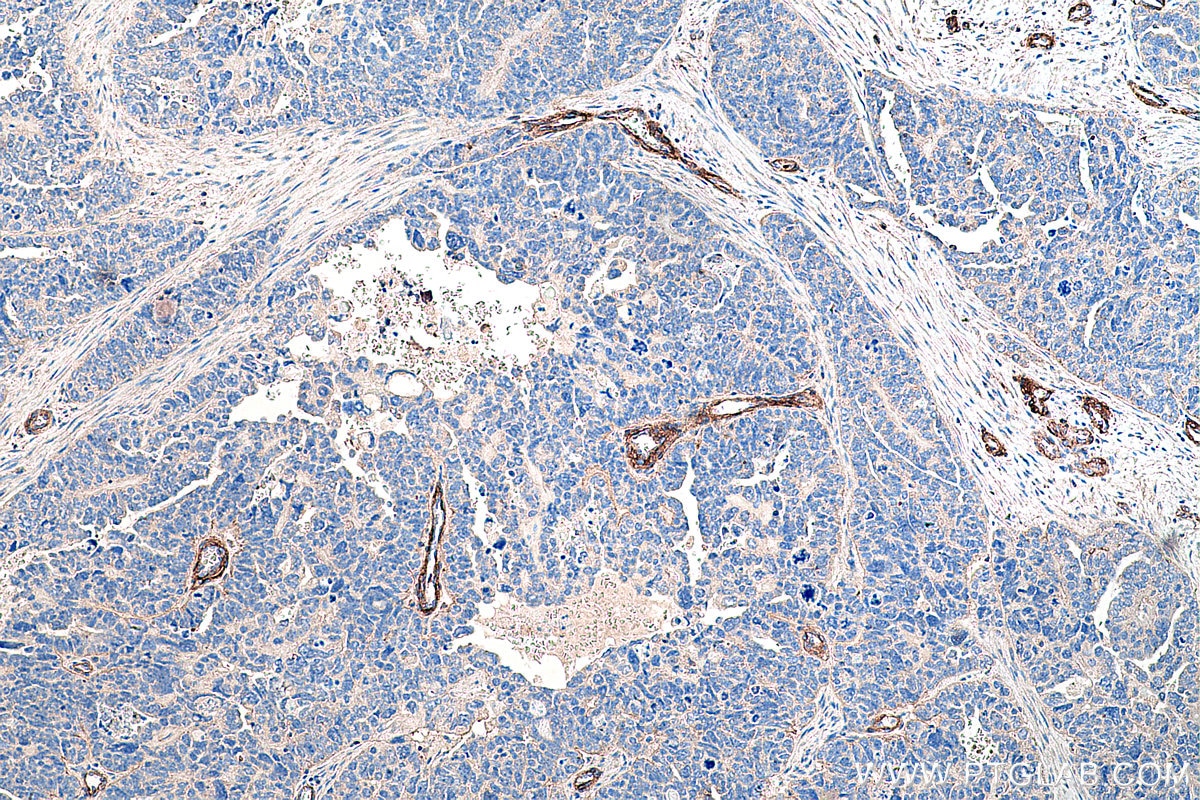 Immunohistochemistry (IHC) staining of human ovary tumor tissue using Entactin Monoclonal antibody (67310-1-Ig)