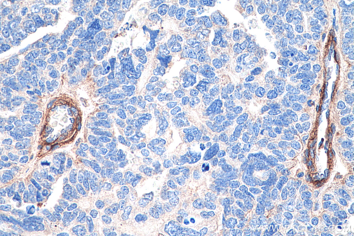 Immunohistochemistry (IHC) staining of human ovary tumor tissue using Entactin Monoclonal antibody (67310-1-Ig)