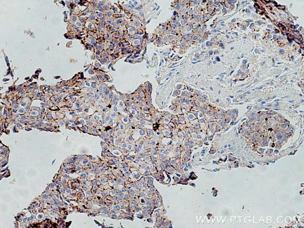 Immunohistochemistry (IHC) staining of human breast cancer tissue using F11R Polyclonal antibody (16183-1-AP)