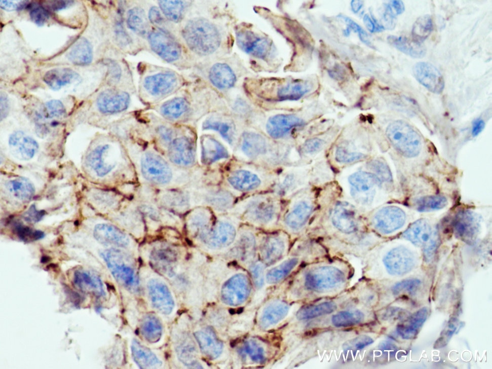 Immunohistochemistry (IHC) staining of human breast cancer tissue using F11R Polyclonal antibody (16183-1-AP)