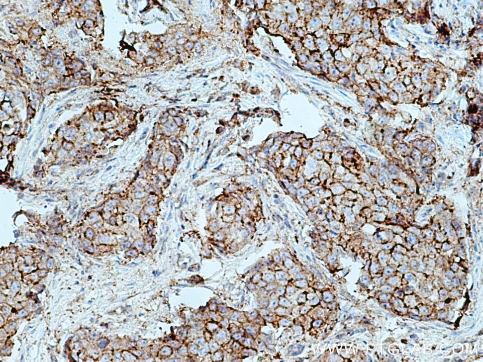 Immunohistochemistry (IHC) staining of human breast cancer tissue using F11R Polyclonal antibody (26941-1-AP)