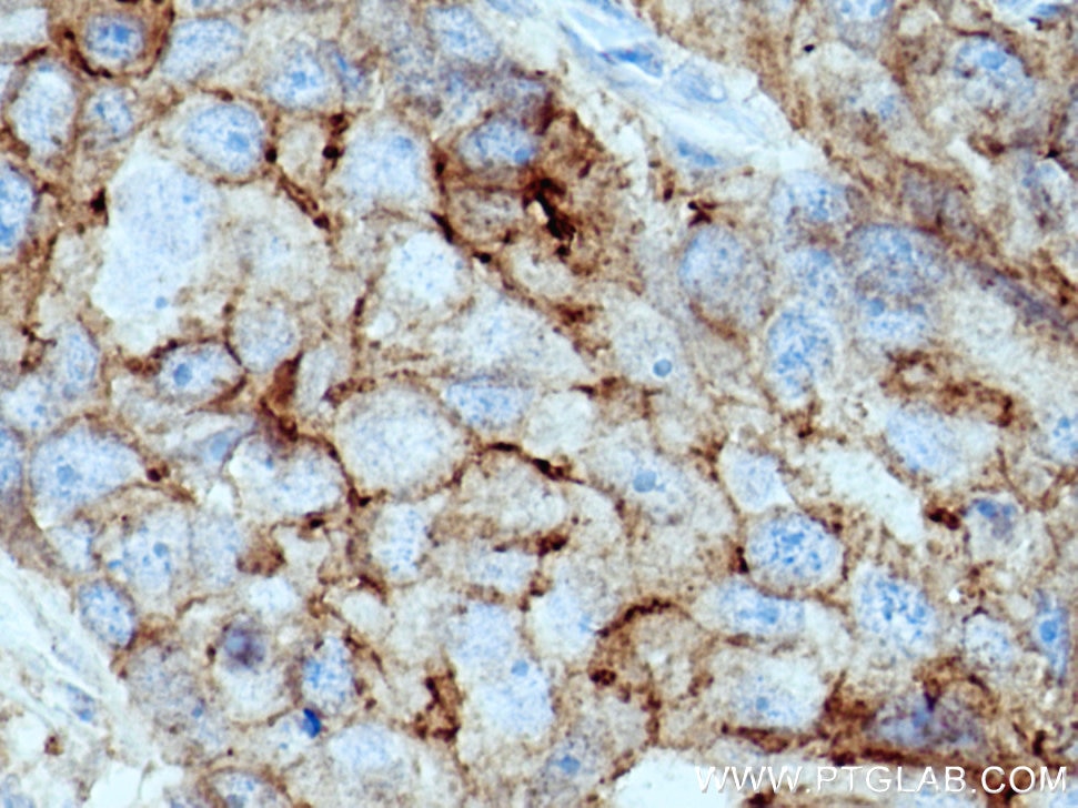 Immunohistochemistry (IHC) staining of human breast cancer tissue using F11R Polyclonal antibody (26941-1-AP)