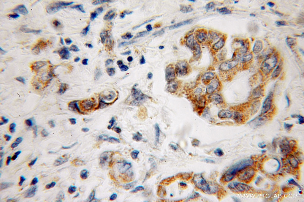 Immunohistochemistry (IHC) staining of human colon cancer tissue using Factor XII Polyclonal antibody (12551-1-AP)