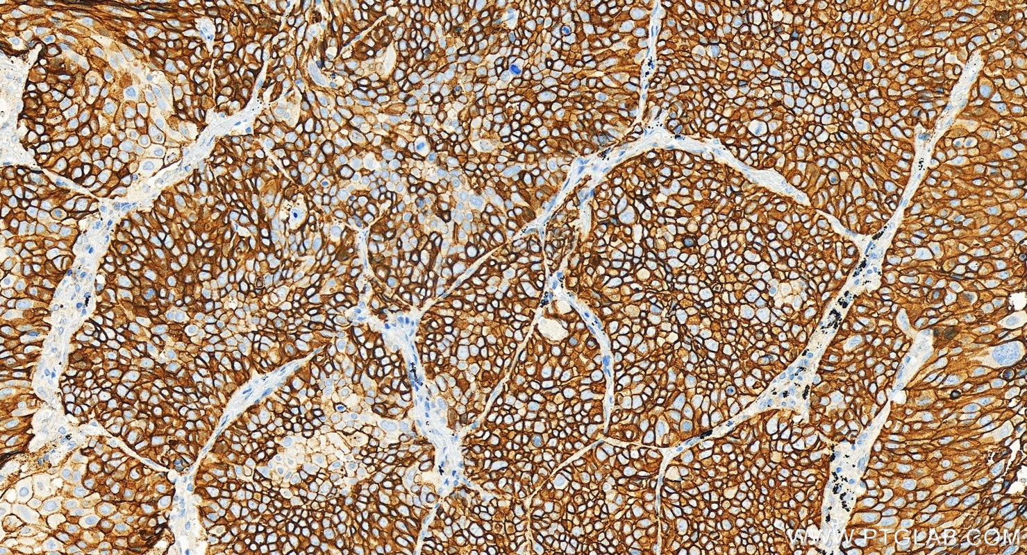 Immunohistochemical analysis of paraffin-embedded human lung squamous cell cancer slide using 67056-1-Ig (Tissue Factor antibody) at dilution of 1:4000 (under 20x lens). Heat mediated antigen retrieval with Tris-EDTA buffer (pH 9.0). This data was developed using the same antibody clone with 67056-1-PBS in a different storage buffer formulation. Immunohistochemistry (IHC) staining of human lung squamous cell cancer using Tissue Factor/CD142 Monoclonal antibody (67056-1-Ig)