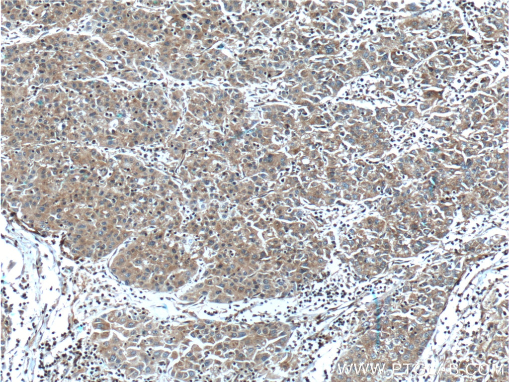Immunohistochemistry (IHC) staining of human liver cancer tissue using F5 Polyclonal antibody (20963-1-AP)