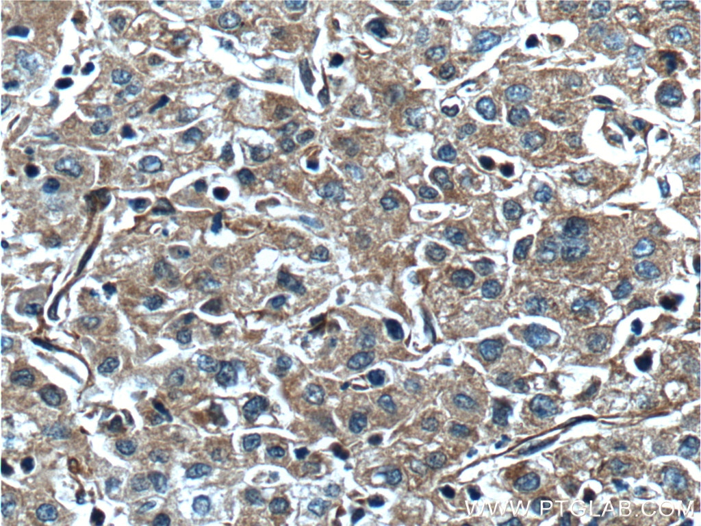 Immunohistochemistry (IHC) staining of human liver cancer tissue using F5 Polyclonal antibody (20963-1-AP)