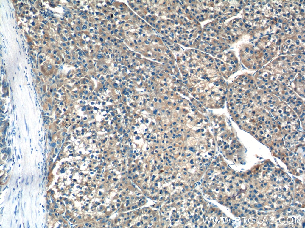 Immunohistochemistry (IHC) staining of human liver cancer tissue using F9 Polyclonal antibody (21481-1-AP)