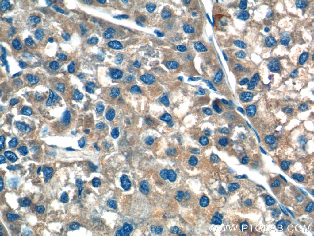 Immunohistochemistry (IHC) staining of human liver cancer tissue using F9 Polyclonal antibody (21481-1-AP)