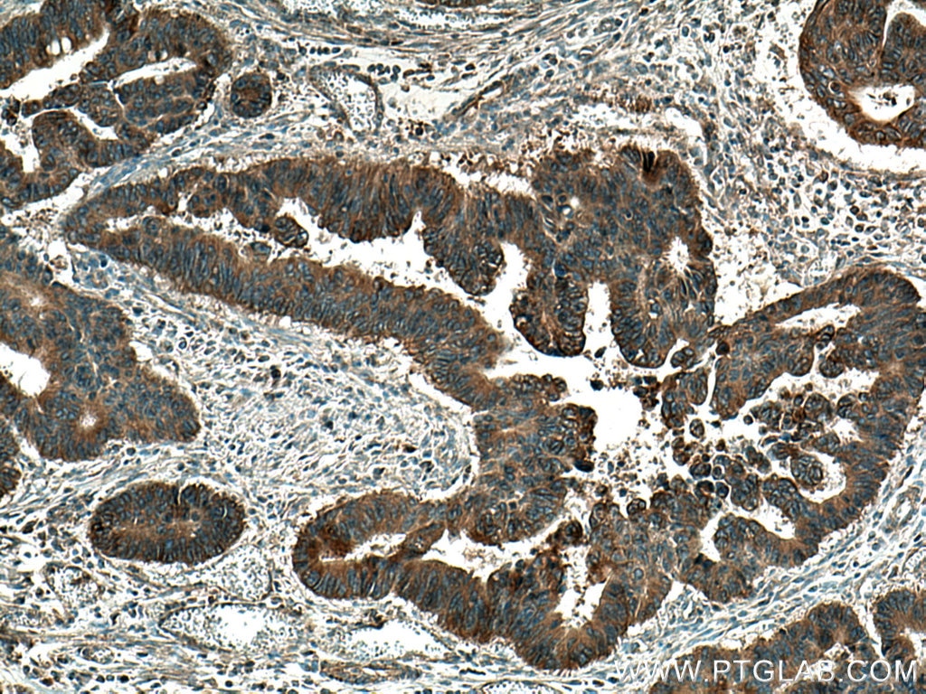 Immunohistochemistry (IHC) staining of human colon cancer tissue using FA2H Polyclonal antibody (15452-1-AP)