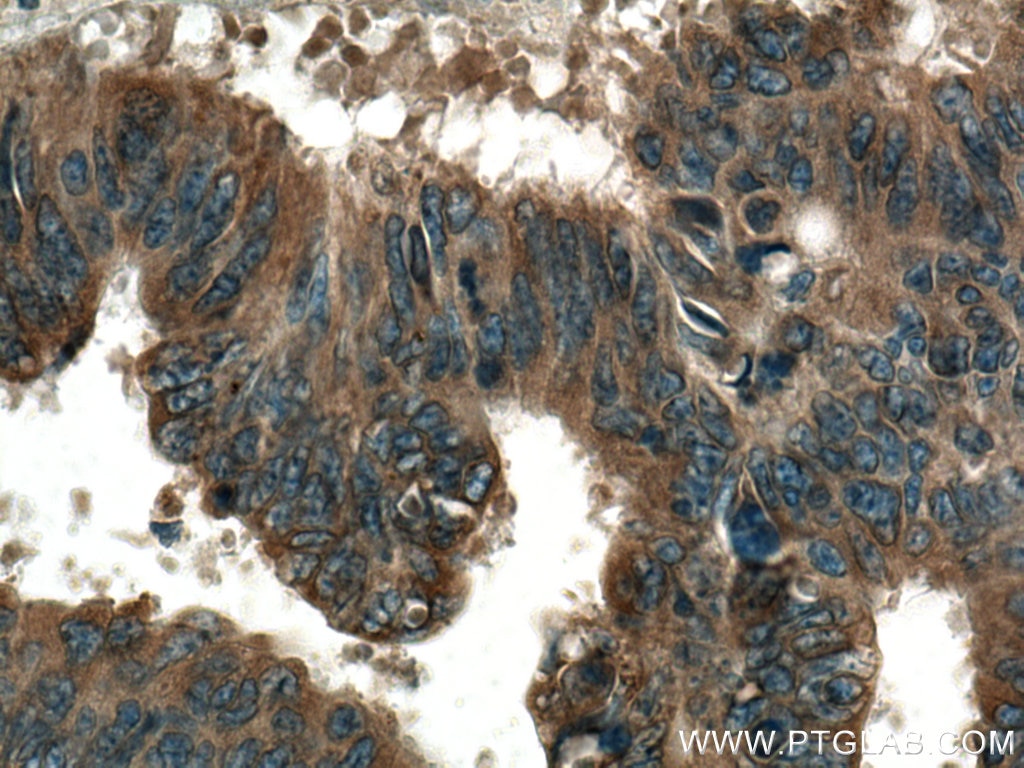 Immunohistochemistry (IHC) staining of human colon cancer tissue using FA2H Polyclonal antibody (15452-1-AP)