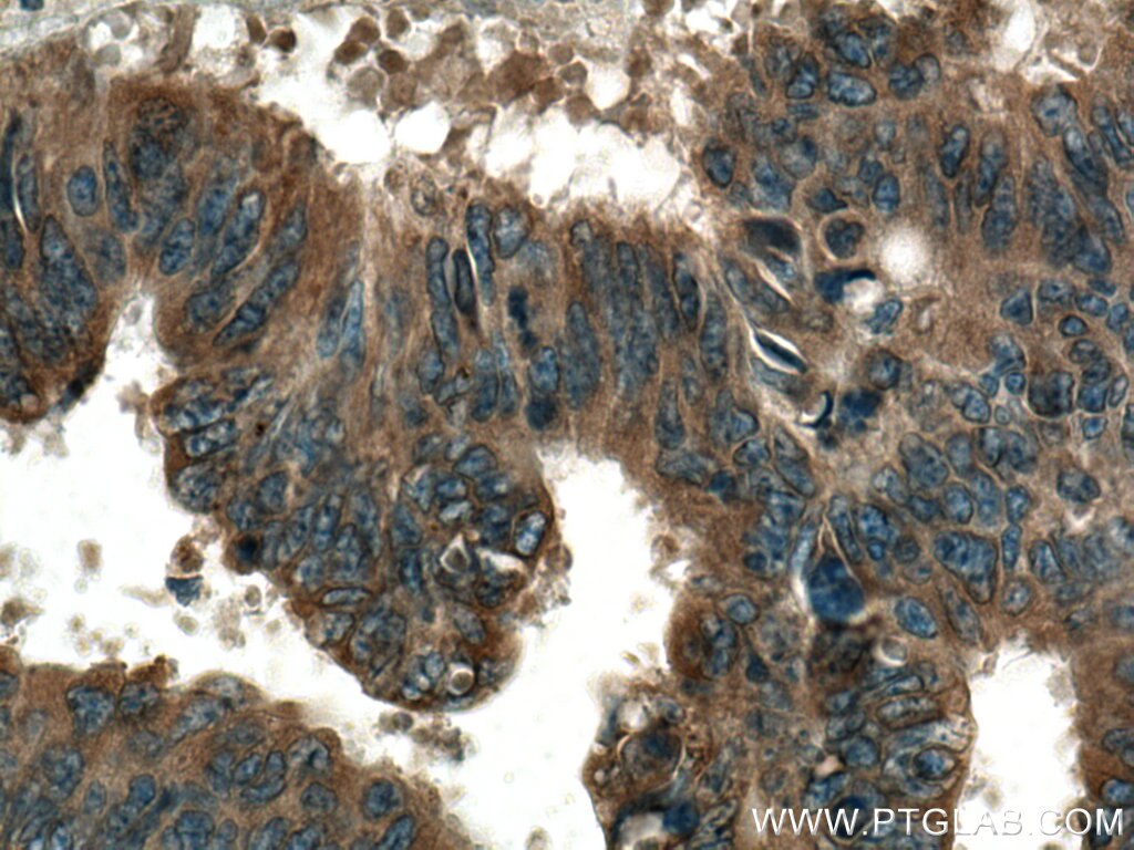 IHC staining of human colon cancer using 15452-1-AP