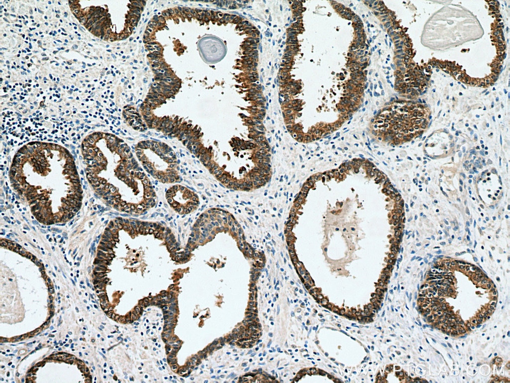 Immunohistochemistry (IHC) staining of human prostate cancer tissue using FAAH Monoclonal antibody (67607-1-Ig)