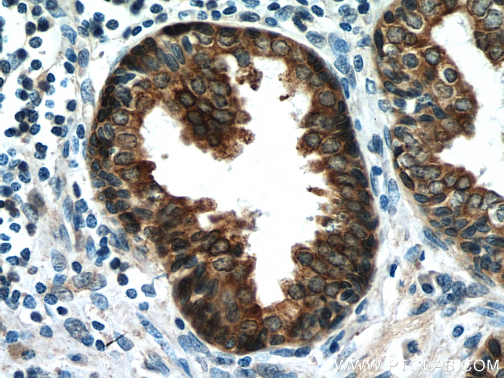 Immunohistochemistry (IHC) staining of human prostate cancer tissue using FAAH Monoclonal antibody (67607-1-Ig)