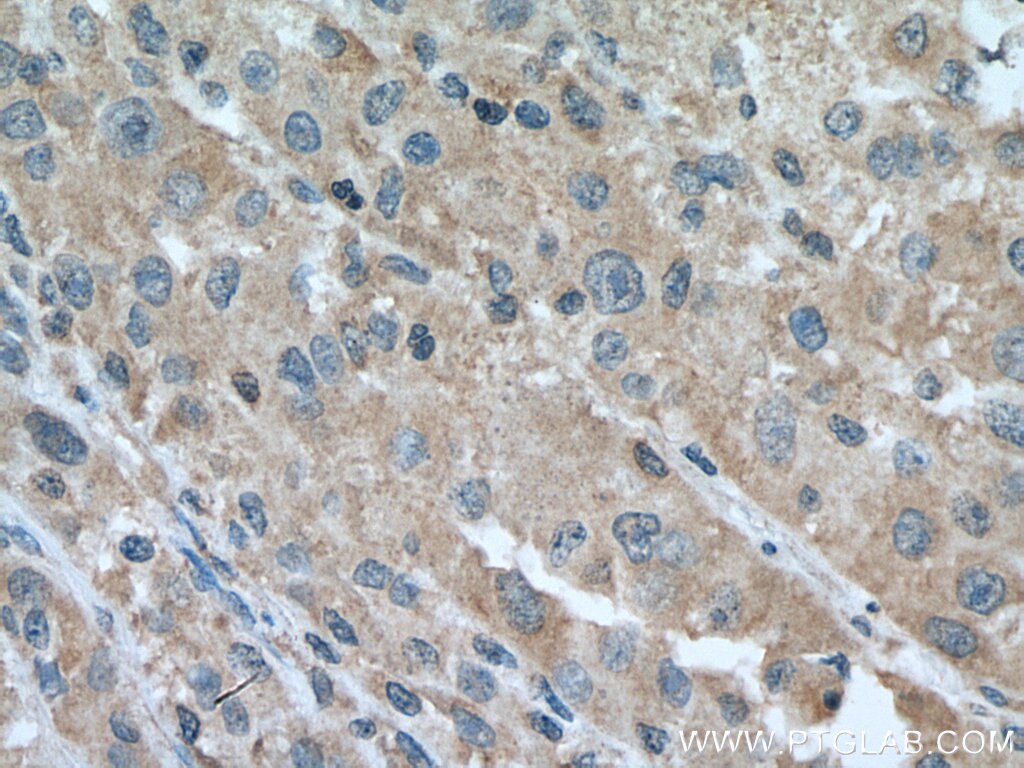 Immunohistochemistry (IHC) staining of human liver cancer tissue using FAAH Monoclonal antibody (67607-1-Ig)