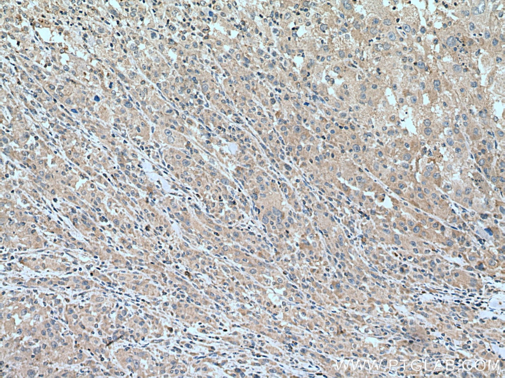 Immunohistochemistry (IHC) staining of human liver cancer tissue using FAAH Monoclonal antibody (67607-1-Ig)