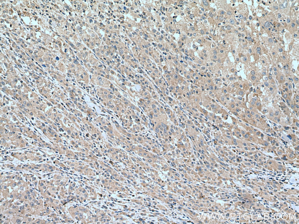 IHC staining of human liver cancer using 67607-1-Ig