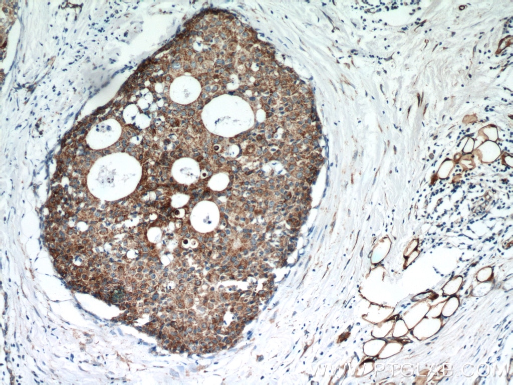 IHC staining of human breast cancer using 10676-1-AP