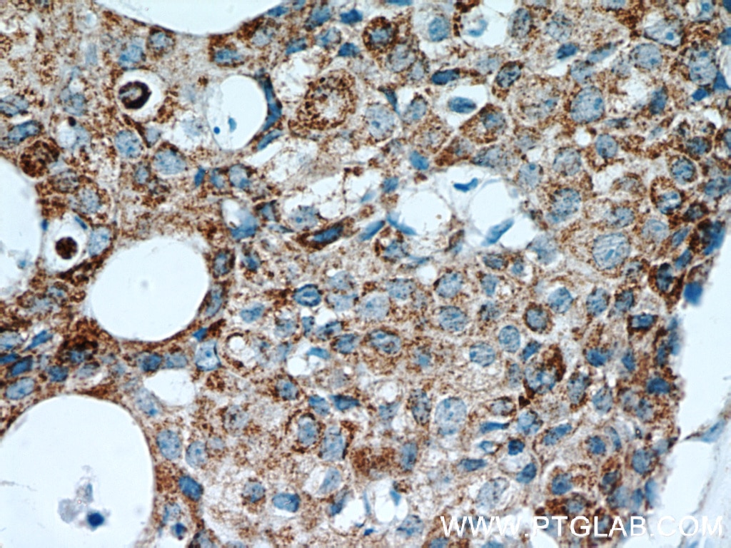 Immunohistochemistry (IHC) staining of human breast cancer tissue using FABP3 Polyclonal antibody (10676-1-AP)