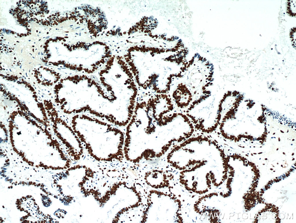 IHC staining of human ovary tumor using 12802-1-AP