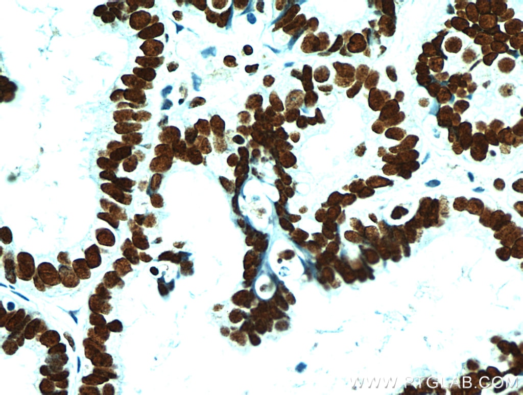 Immunohistochemistry (IHC) staining of human ovary tumor tissue using FABP4 Polyclonal antibody (12802-1-AP)